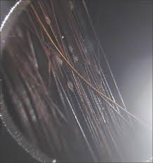 1,7 affected hair may become brittle and break at points of invasion.1 alternatively, wp may resemble tinea capitis with scalp hyperkeratosis and alopecia, though tinea typically affects the base of the hair shaft. A Case Of Scalp White Piedra Caused By Trichosporon Ovoides Singh A Nyati A Mohta A Kushwaha Rk Jain Sk Int J Trichol