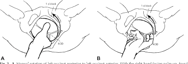 Image result for Manual Rotation in Occipitoposterior Presentation
