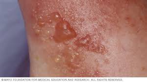 Image result for dermatitis contacta allergica