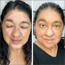 Vitiligo Concealer Starter Kit