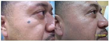 See top providers, read unbiased reviews from real people, check out prices, and ask questions at. Laser Tattoo Removal Jupiter Miami Fl Tattoo Removal