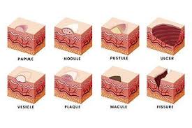 Image result for Macule
