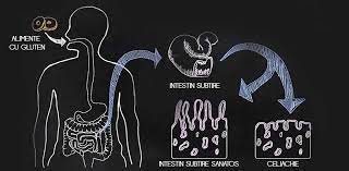 Instead, diagnosis is usually based on the following common symptoms. Simptome Celiachie Diagnostic Intoleranta La Gluten