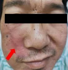 The symptom of facial paralysis in this patient