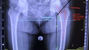 Neue Hufte Neues Knie Das Implantierte Gelenk Braucht Muskulatur Archiv