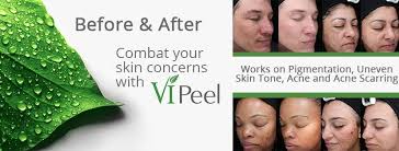 Image result for vi peel