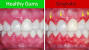 Healthy Gums
