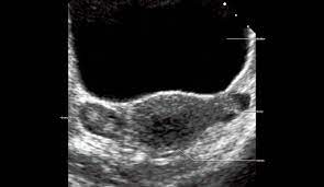 Nonvisualization of the ovaries on pelvic ultrasound: Ovary An Overview Sciencedirect Topics