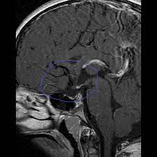 File Pituitary Stalk Interruption Syndrome 1 Jpg Wikidoc