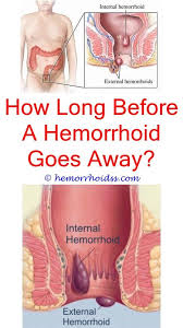 Pin On Epsom Salt For Hemorrhoids