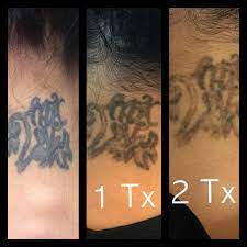 Fresh start laser clinic, austin. Tattoo Removal Specialist Cedar Park Tx Luxe Laser And Wellness Spa Laser Medical Spa