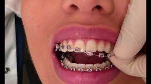 The braces will come off easily and quickly from the teeth. How Braces Are Removed Youtube