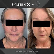 sylfirmx #sylfirmxmicroneedling #rfmicroneedling #facialtightening…