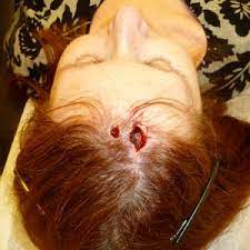 Learn about the academy's efforts to refocus its brand on education. A Hole In My Head The Skin Cancer Foundation