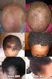 Before And After Photos Jbco Castor Oil For Hair Growth Castor Oil For Hair Oil For Hair Loss
