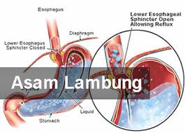 Namun jika asam lambung naik terlalu sering, cari cara lain karena baking soda atau sodium bikarbonat mengandung garam yang namun demikian, diingatkan bahwa tidak semua gangguan asam lambung cocok diobati dengan pisang. Cara Mengobati Asam Lambung Tanpa Efek Samping Shintia Herbal