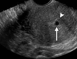 Till now you might have got some idea about the. Physiologic Histologic And Imaging Features Of Retained Products Of Conception Radiographics