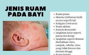 Jadi mulailah kita menggunakan istilah medis demi. Ruam Pada Bayi Pusat Rawatan Impian