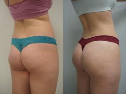 On average, therefore, it can cost between £6,250 and £7,000 or sometimes more. Brazilian Butt Lift For Chandler Scottsdale Az Dr Josh Olson