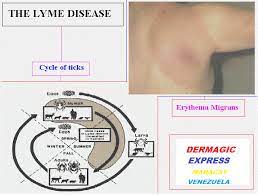 The Minocycle In Lyme Disease