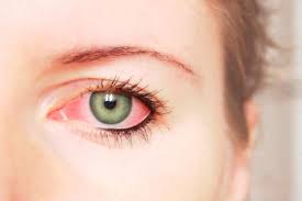 Derrame Ocular Que Es Y Causas De Hemorragia En El Ojo