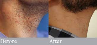 Later on, we plan to make research and explore if current parameters are causing no hazard or danger to your. Ditch The Neck Hair Laser Hair Removal For Men Plastic Surgery Associates