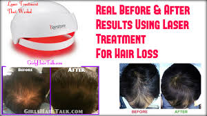 Treatment for hair loss and thinning hair in women. Laser Treatment For Hair Loss Tips For Faster Regrowth