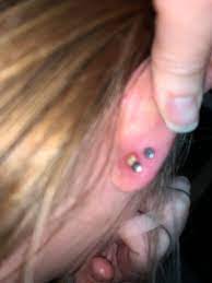 3 Month Old Second Lobe Piercing Developed This Pus Filled Bump In The Last Day Or Two Additional Info In Comments Piercingadvice