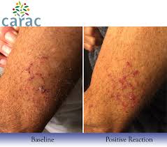Actinic keratosis is a rough, scaly patch or bump on the skin. Actinic Keratosis Dr Heather Roberts