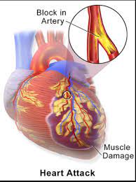 Myocardial Infarction All You Need To Know About Being A Medical Student Heart Attack Medicostudy Heart Failure Treatment Myocardial Infarction Heart Attack