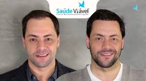 Implante capilar guardo seguro terapias efectiva como un experimentarios ejercicio vigoroso demasiado pronto después de. Transplante Capilar Na Clinica Saude Viavel Testemunho By Saude Viavel