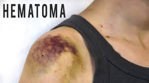 Home Remedies To Get Rid Of A Hematoma Home Remedies Hematoma Treatment Remedies