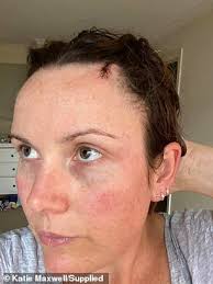 We may earn commission from links on this page, but we only recommend products we back. Katie Maxwell Reveals How A Tiny Lump On Her Head Turned Out To Be Skin Cancer Daily Mail Online