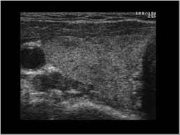 Graves' disease, also known as toxic diffuse goiter, is an autoimmune disease that affects the thyroid. Head And Neck 4 1 Thyroid Gland Case 4 1 4 Thyroiditis And Diffuse Thyroid Disease Ultrasound Cases