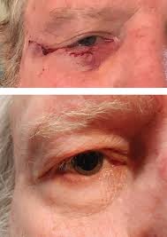 A small lump or bump on the eyelid could be a form of skin cancer. A Close Look At Common Lid Lesions