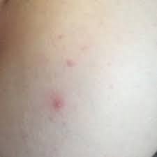 What Are These They Re On My Butt Cheek And It S Really Gross And I Don T Know What It Is Glow Community