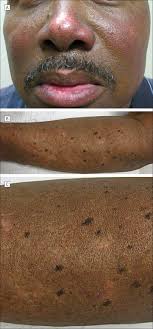 Clinical images. A, Prominent erythema