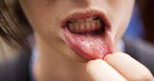 In the mouth, it most commonly starts as a painless white patch, that thickens, develops red patches. Lip Cancer Symptoms Causes Treatments