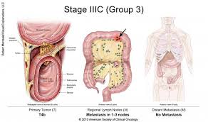 Thickening or a lump in any part of the body. Colorectal Cancer Stages Cancer Net