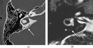 Imaging And Clinical Findings In Large Endolymphatic Duct And Sac Syndrome European Journal Of Radiology