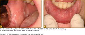 Image result for Labial mucosa