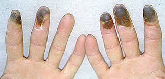 Buerger S Disease Johns Hopkins Vasculitis Center