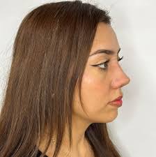 Fotografías de nuestra bella paciente a tan solo 1 mes de su rinoplastia  estructural ultrasónica!!💯💯✔️✔️ En este caso nuestra paciente nos una  nariz natural y ligeramente respingada y con mayor definición, nuestra