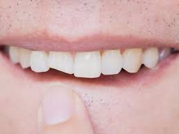 We did not find results for: Gigi Retak Atau Patah Segera Atasi Dengan Cara Ini