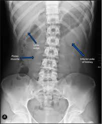 Abdominal X Ray Interpretation Axr Radiology Osce Geeky Medics