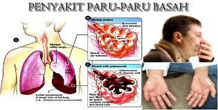 17 pengairan disebabkan jangkitan bakteria dirawat dengan antibiotik , 11 jangkitan tahap lebih parah boleh memaksa perawatan. Paru Paru Basah Gejala Ciri Ciri Penyebab Cara Menyembuhkan Full