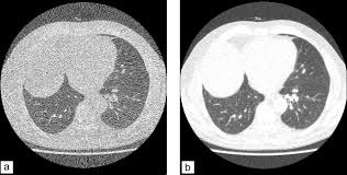 Le scanner est l'examen de base. Scanner Thoracique Ultra Basse Dose La Mort De La Radiographie Thoracique Sciencedirect