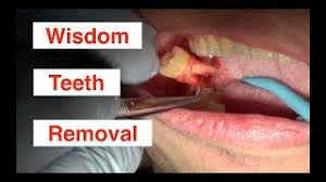 The jaw bone's tissue takes a longer time to heal and fill in the socket than your gums. Wisdom Teeth Removal Wisdom Tooth Extraction Dental Care
