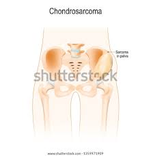 Image result for Chondrosarcoma