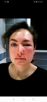 🐝 Piqûres d'insecte chez l'enfant 🐝 🥂 Quand Jeremhy s'est fait piquer  alors que le reste de la famille prenait tranquille un barbeuc-apéro sur la  terrasse,